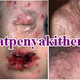 Illustration for article titled Pengobatan Penyakit Herpes